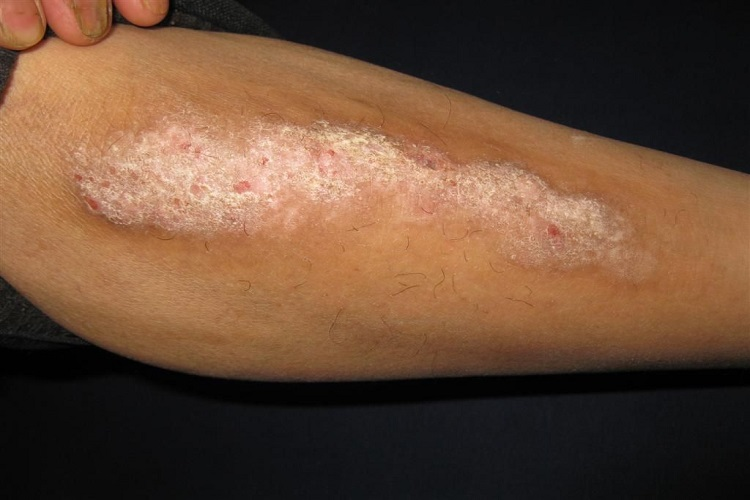 手臂外侧神经性皮炎图