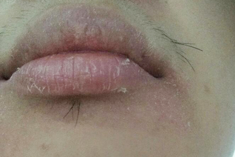 慢性脱屑性唇炎嘴巴肿图
