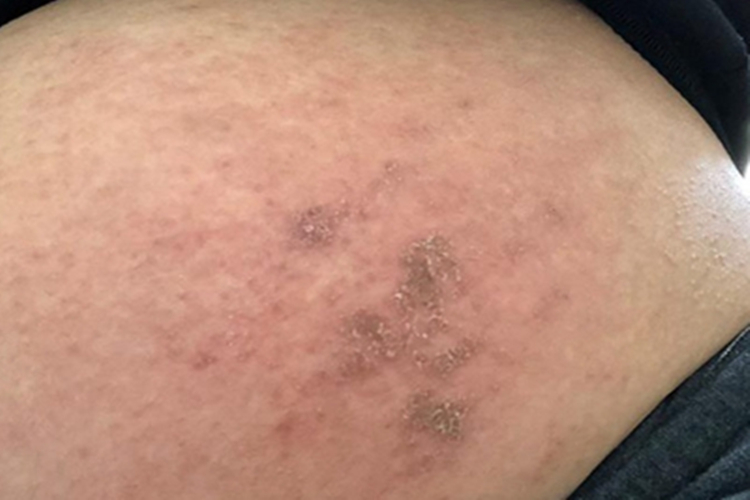 慢性湿疹皮肤增厚图