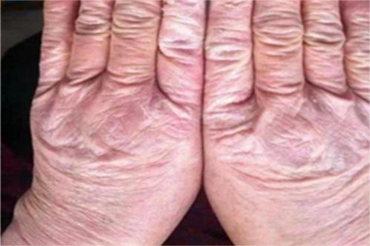 手部湿疹手背皮肤粗糙图