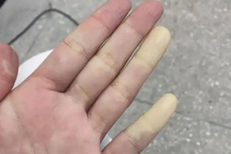 雷诺综合征手指发白图