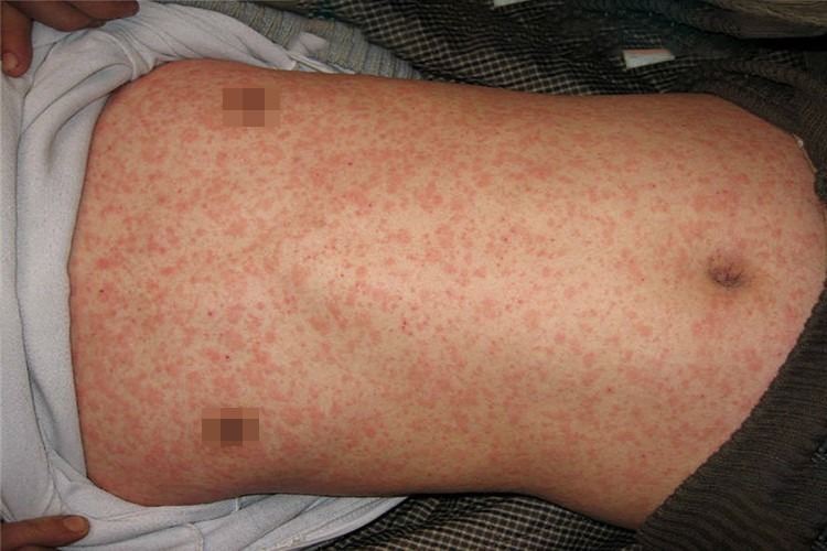 麻疹样皮肤图