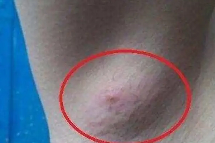 淋巴结炎腋下淋巴结肿大图