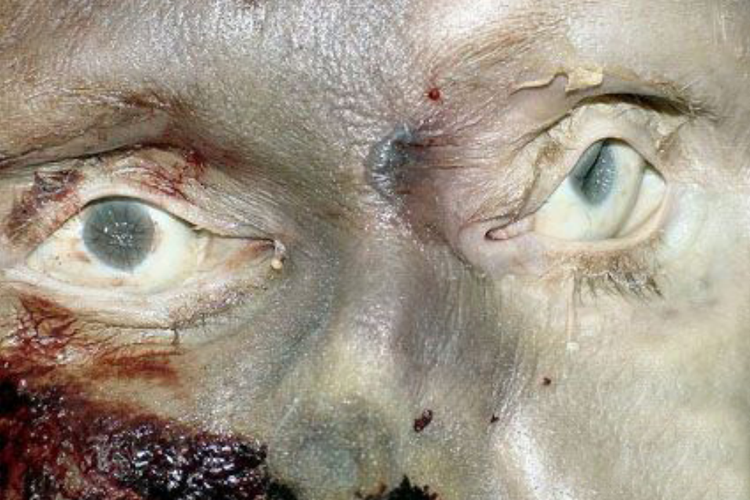 卟啉病眼损害图