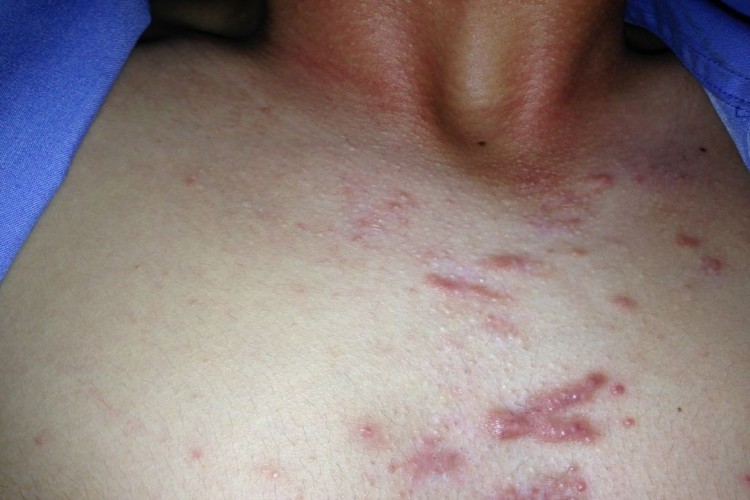 马拉色菌毛囊炎胸部大红疙瘩图
