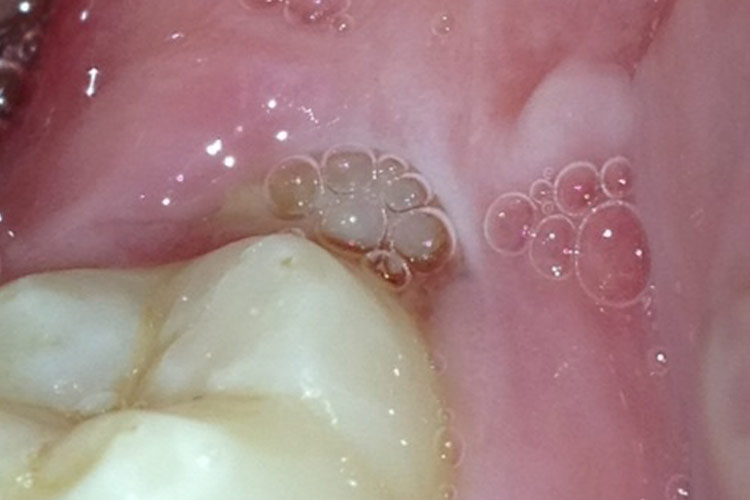 口腔增生性白斑图