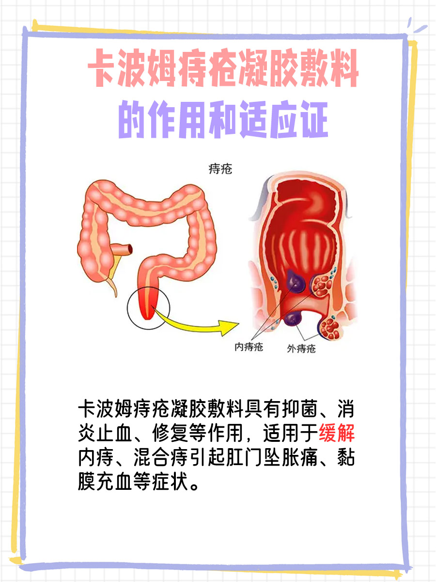 对付痔疮，马应龙和卡波姆谁更胜一筹？
