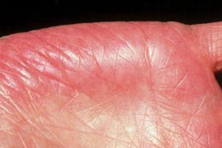 遗传性掌红斑手掌红斑图