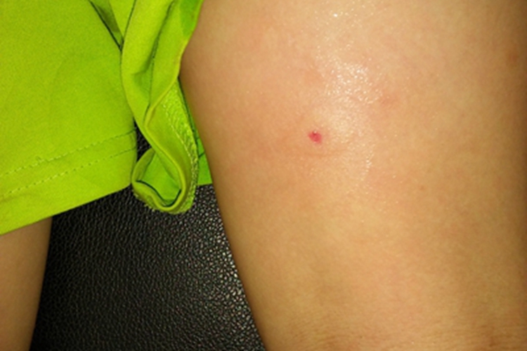 蜂蜇伤大腿症状图