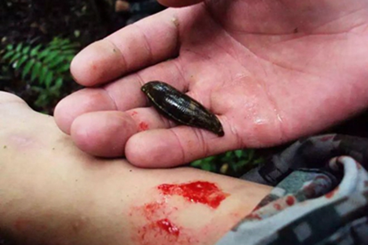 水蛭咬伤胳膊出血图