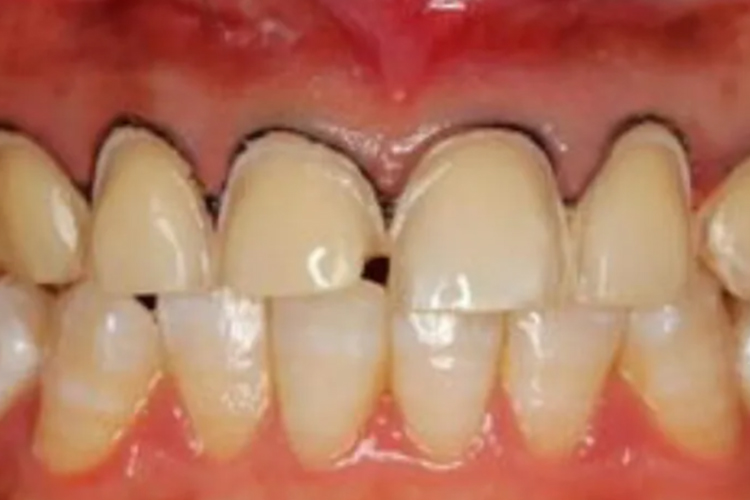 异常牙龈铅线颜色图