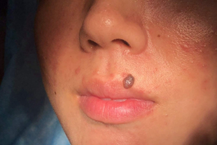 皮内痣嘴唇症状图