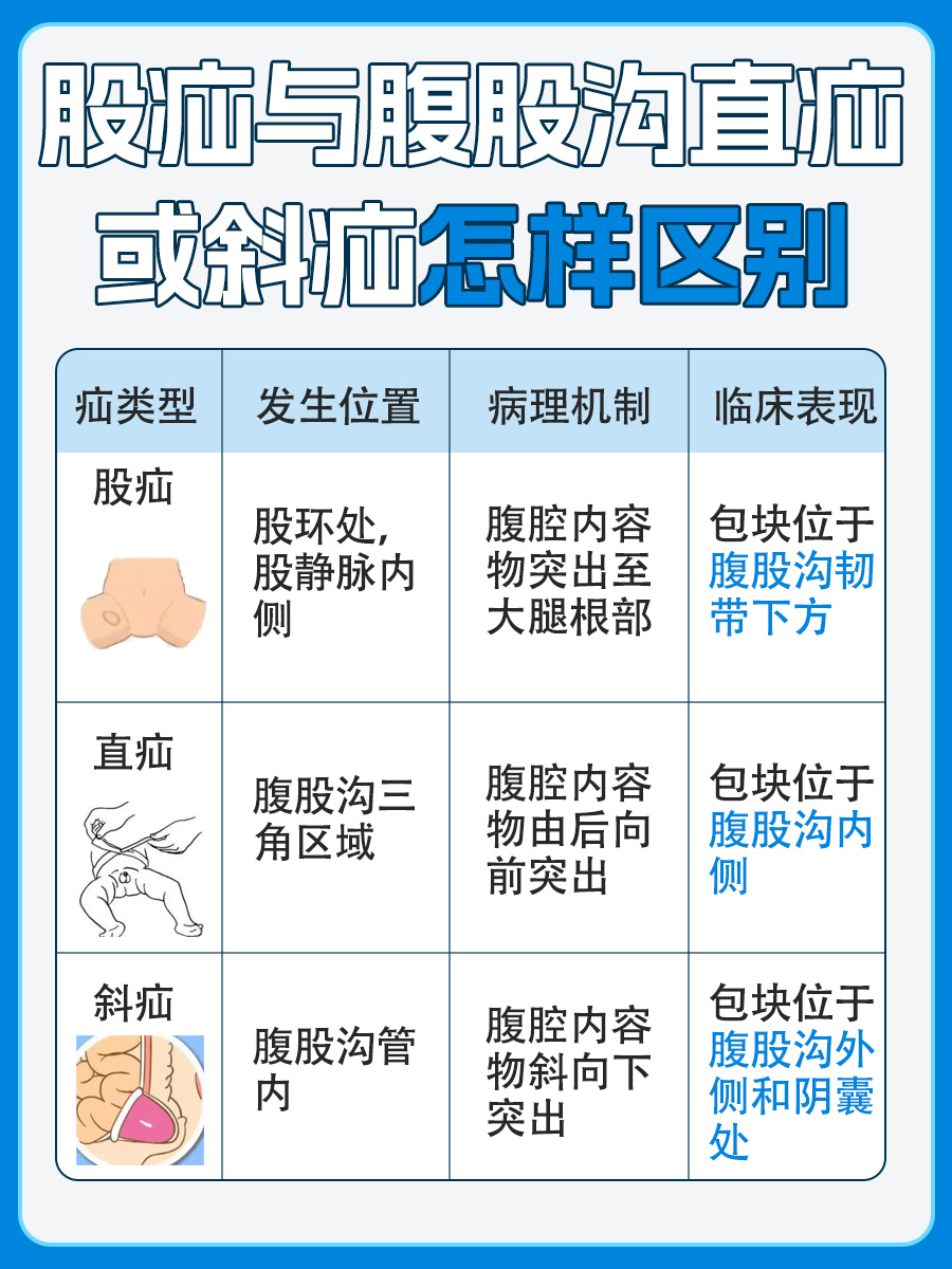 股疝、腹股沟直疝与斜疝，区别诊断