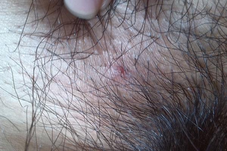 外阴毛囊炎图