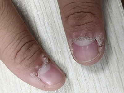 寻常疣手指指甲周围皮肤粗糙图.jpg