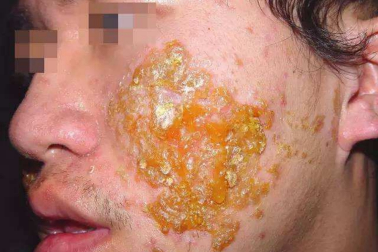 男生急性湿疹图