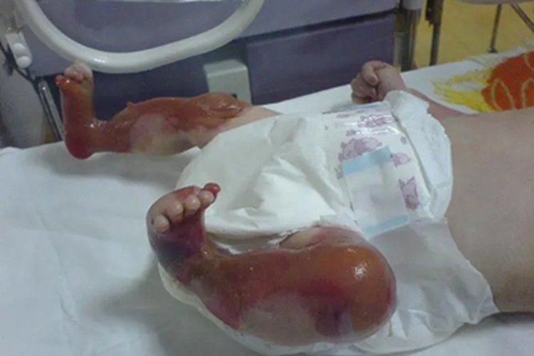 获得性大疱性表皮松解症腿脱皮图