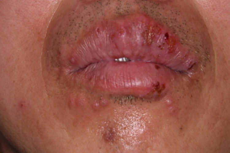 复发性口腔单纯性疱疹口周症状图 复发性口腔单纯性疱疹口周症状图