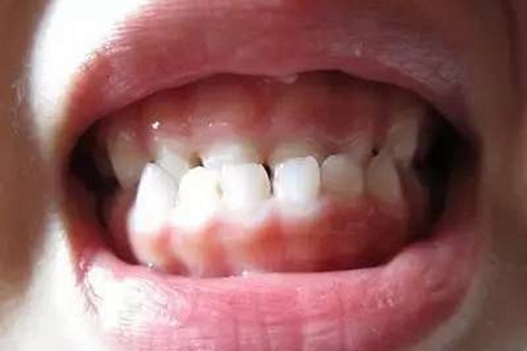 下牙深覆(牙合)图