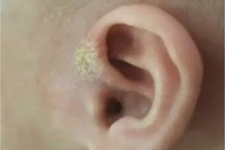 奶癣耳周黄痂图