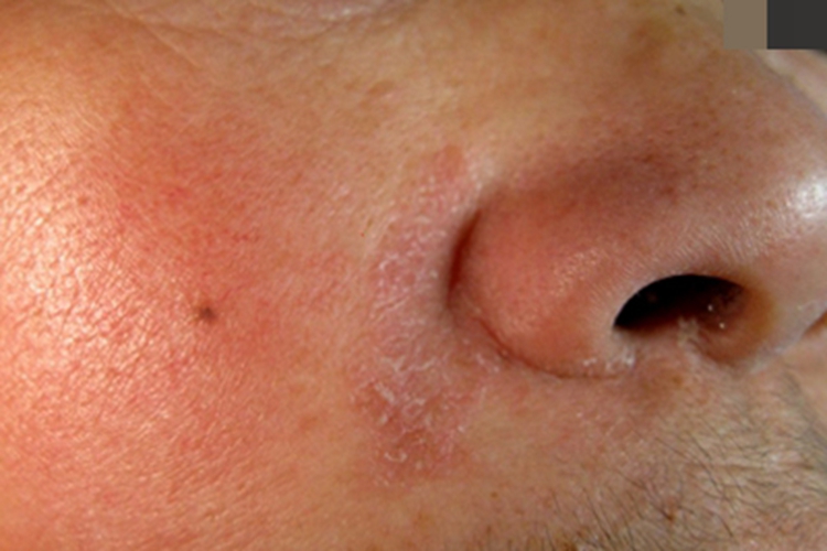 皮脂溢出面部红斑上有脱屑图