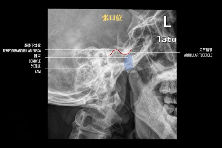 颞颌关节张口位X线图 颞颌关节张口位X线图