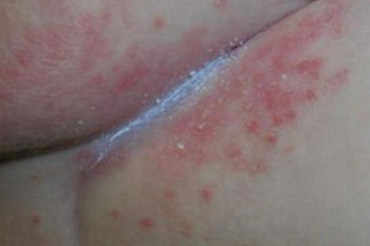 小儿丘疹性肢端皮炎臀部小疙瘩图