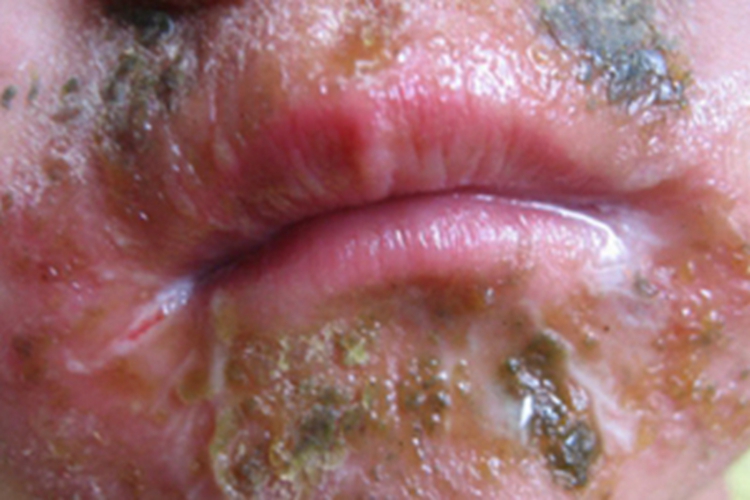 脓疱疮口周渗液图