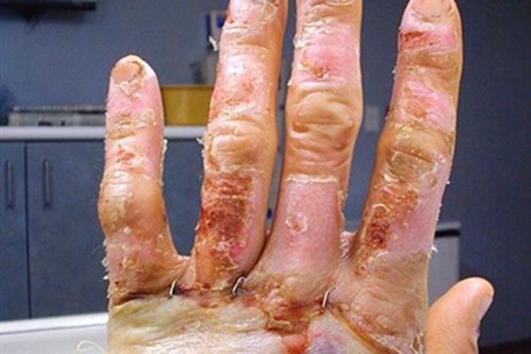 深Ⅱ度烧伤手指症状图 深Ⅱ度烧伤手指症状图