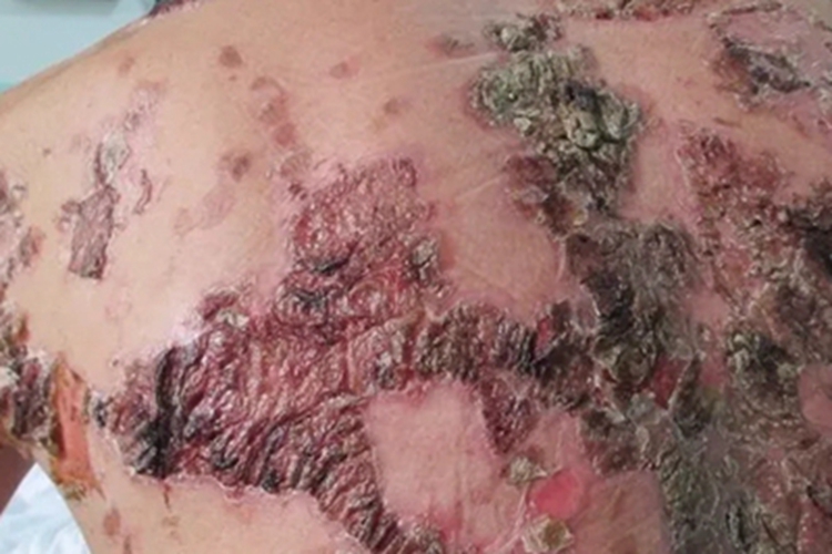 疱疹样天疱疮背部结痂图 疱疹样天疱疮背部结痂图