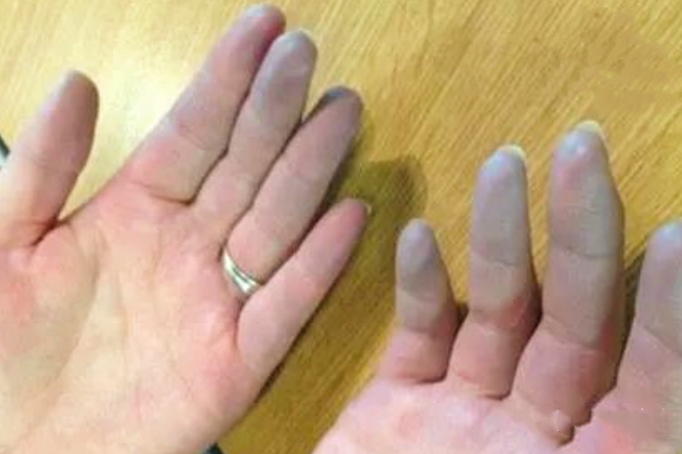 雷诺病皮肤发青图