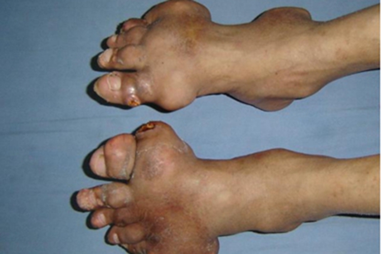 痛风脚部赘生物图 痛风脚部赘生物图