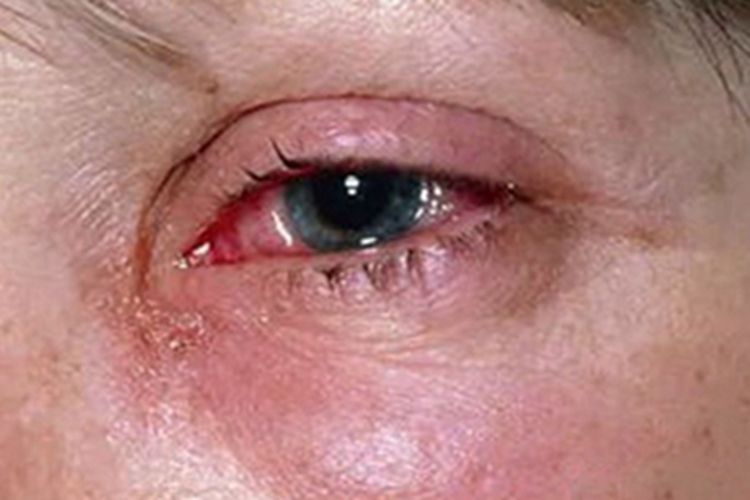 细菌性结膜炎渗液图 细菌性结膜炎渗液图