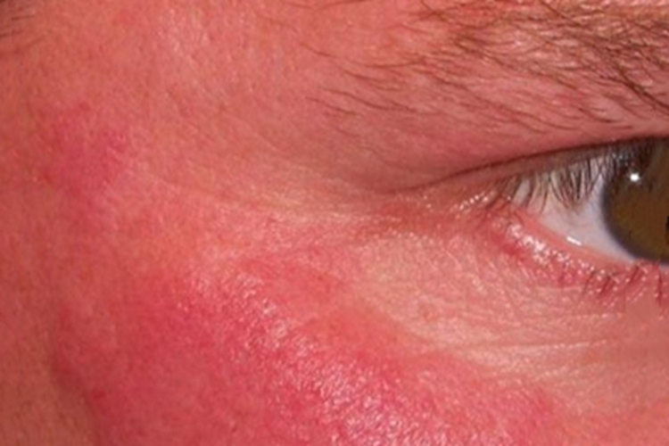 皮肤淋巴细胞浸润症眼周症状图 皮肤淋巴细胞浸润症眼周症状图