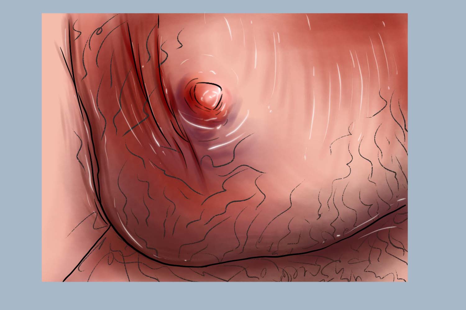 输精管结核阴囊破溃图 输精管结核阴囊破溃图