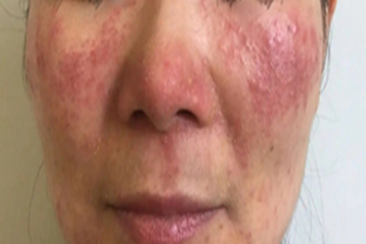 暴发性玫瑰痤疮脸有红疙瘩脱屑图