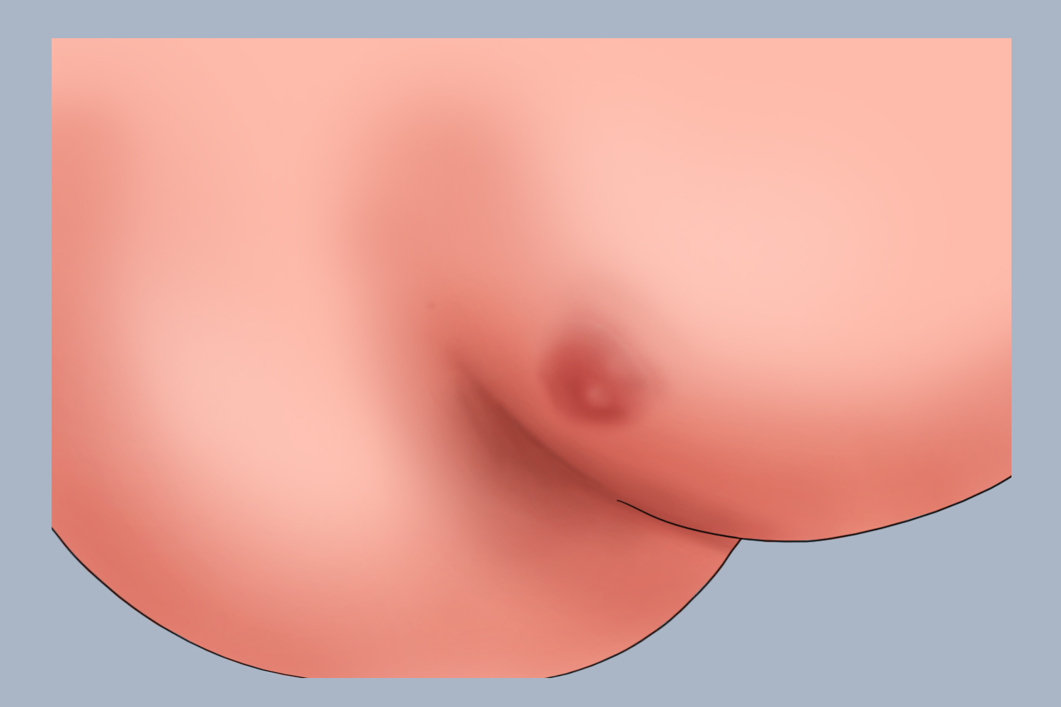 婴儿肛瘘图 婴儿肛瘘图