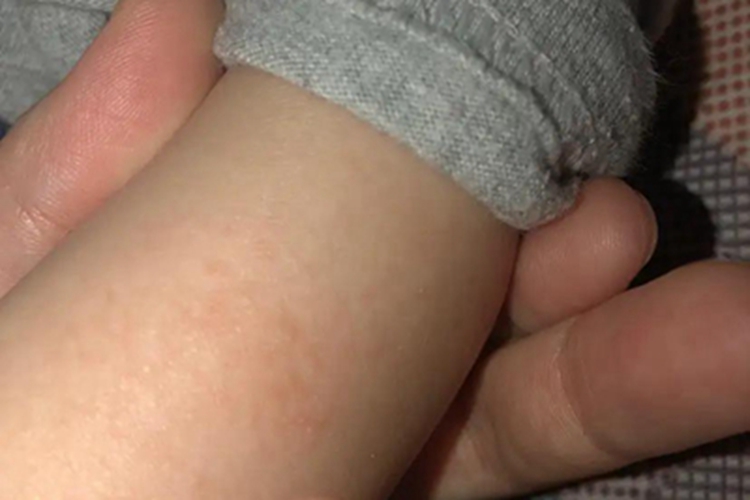 干性湿疹胳膊有浅红色斑点图