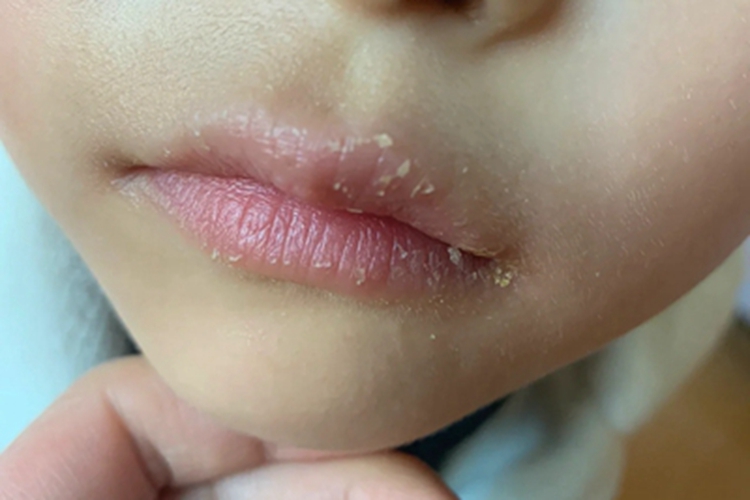 变应性接触性唇炎嘴唇脱屑图 变应性接触性唇炎嘴唇脱屑图