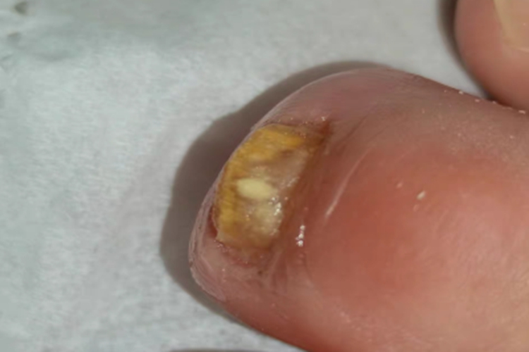 全甲损毁型甲真菌病脚趾甲发黄图 全甲损毁型甲真菌病脚趾甲发黄图