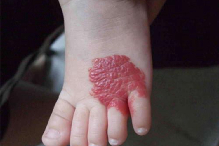 血管瘤脚背肿块图