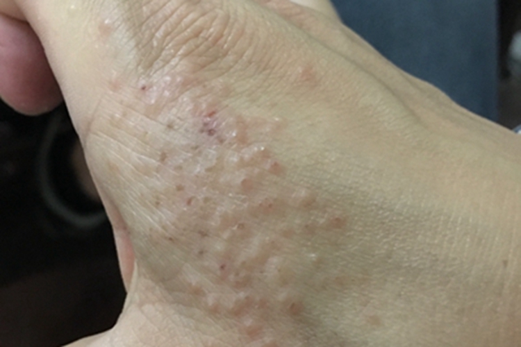 变应性接触性皮炎手背症状图 变应性接触性皮炎手背症状图