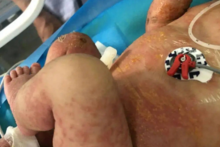 色素失禁症全身红斑图 色素失禁症全身红斑图