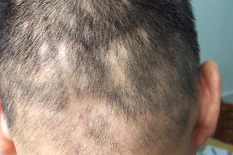 男性梅毒头发症状图