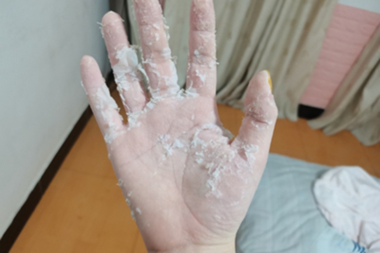 汗疱疹手部大片脱皮图