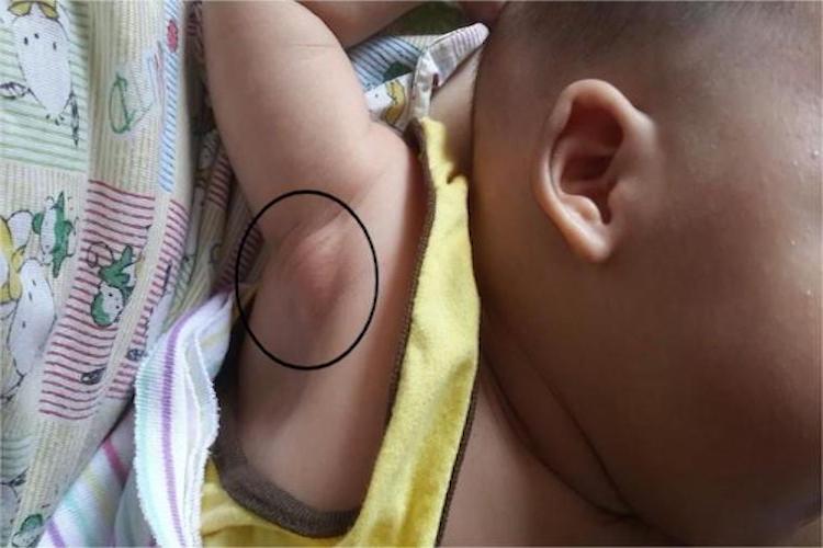 宝宝接种卡介苗腋下淋巴结肿大图