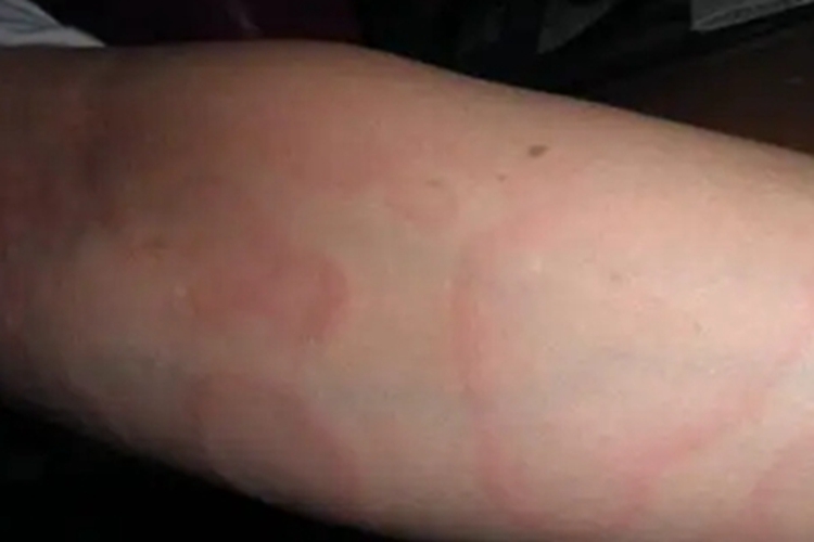 远心性环状红斑胳膊症状图