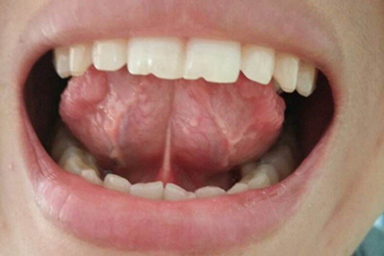 舌癌舌头边缘肿大图