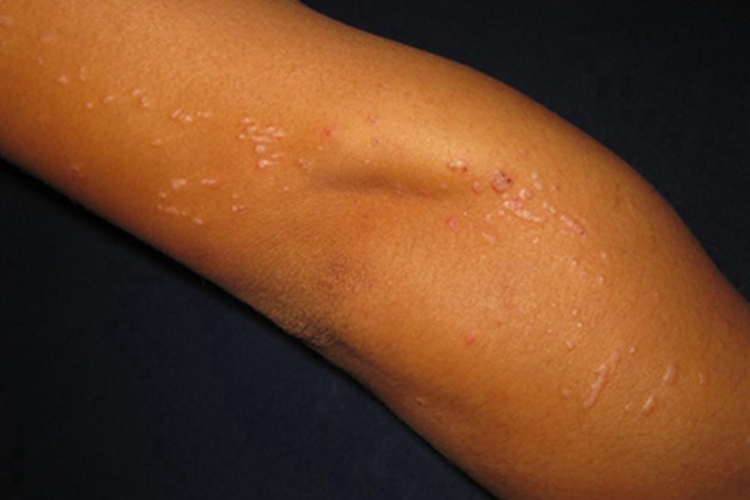 扁平疣胳膊症状图