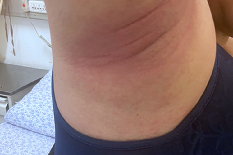 慢性湿疹腋窝下面发红图